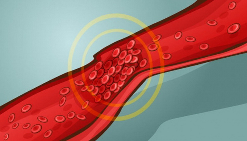 6 ПРИЗНАКОВ ТРОМБА.5 МИНУТ ЧТЕНИЯ, КОТОРЫЕ МОГУТ СПАСТИ ЖИЗНЬ ВАМ И ВАШИМ БЛИЗКИМ!
