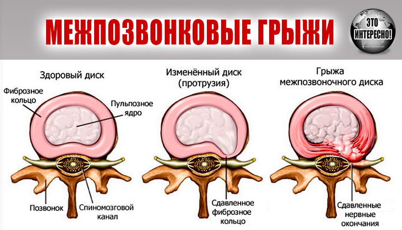МЕЖПОЗВОНКОВЫЕ ГРЫЖИ: ПРИЧИНЫ И МЕТОДЫ РАБОТЫ В ЙОГАТЕРАПИИ