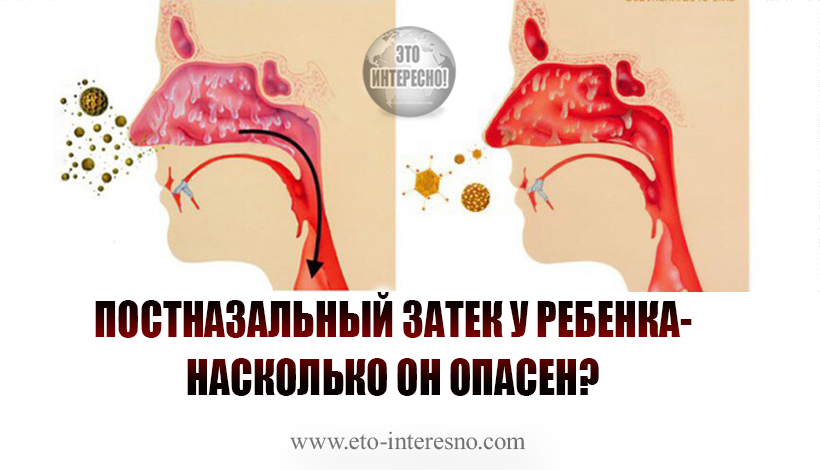 ПОСТНАЗАЛЬНЫЙ ЗАТЕК У РЕБЕНКА-НАСКОЛЬКО ОН ОПАСЕН? И ЧТО ДЕЛАТЬ ЕСЛИ ДЛИТЕЛЬНЫЙ КАШЕЛЬ НЕ ПРОХОДИТ?