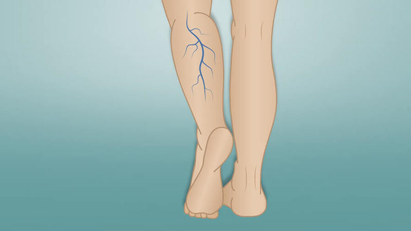 ЕСЛИ У ВАС ВАРИКОЗНОЕ РАСШИРЕНИЕ ВЕН, ОБЯЗАТЕЛЬНО НАЧНИТЕ ДЕЛАТЬ ЭТО!