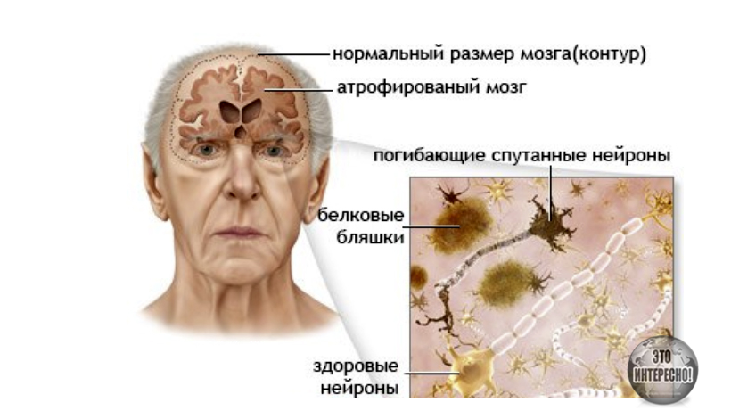 СТАРЧЕСКОЕ СЛАБОУМИЕ КОМУ ОНО ГРОЗИТ И КАК ЕГО ИЗБЕЖАТЬ