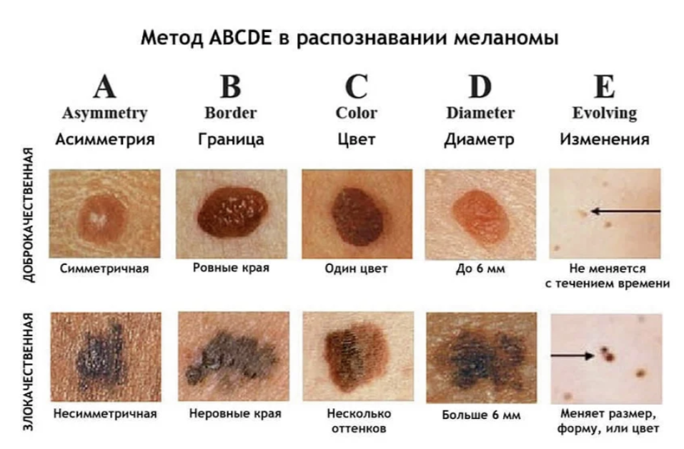 КАКИХ РОДИНОК НУЖНО БОЯТЬСЯ?А ВЫ ЗНАЛИ ОБ ЭТОМ?