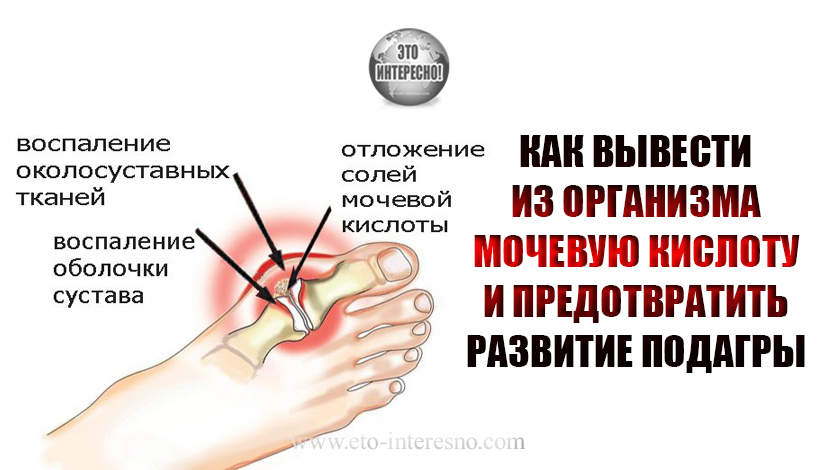 КАК ВЫВЕСТИ ИЗ ОРГАНИЗМА МОЧЕВУЮ КИСЛОТУ И ПРЕДОТВРАТИТЬ РАЗВИТИЕ ПОДАГРЫ