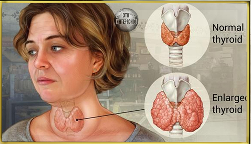 ПРИЗНАКИ ЗАБОЛЕВАНИЙ ЩИТОВИДНОЙ ЖЕЛЕЗЫ: КОГДА БИТЬ ТРЕВОГУ?