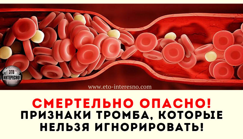 ШЕСТЬ ПРИЗНАКОВ ТРОМБА! СМЕРТЕЛЬНО ОПАСНО!