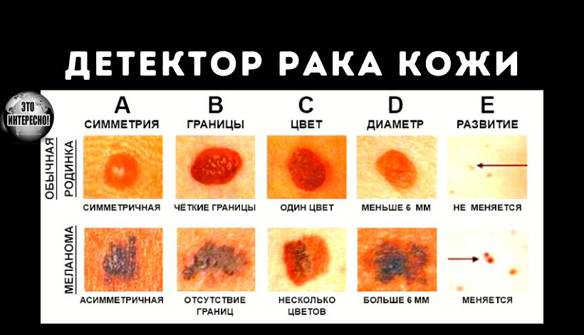 ЭТОТ ДЕТЕКТОР РАКА КОЖИ МОЖЕТ СПАСТИ ВАШУ ЖИЗНЬ. ЗАПОМНИТЕ И ПОДЕЛИТЕСЬ С БЛИЗКИМИ!