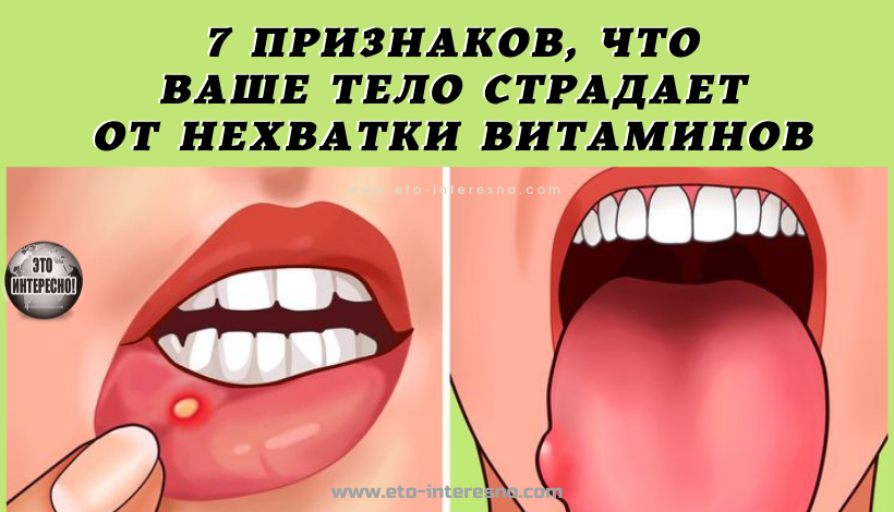 7 ПРИЗНАКОВ, ЧТО ВАШЕ ТЕЛО СТРАДАЕТ ОТ НЕХВАТКИ ВИТАМИНОВ