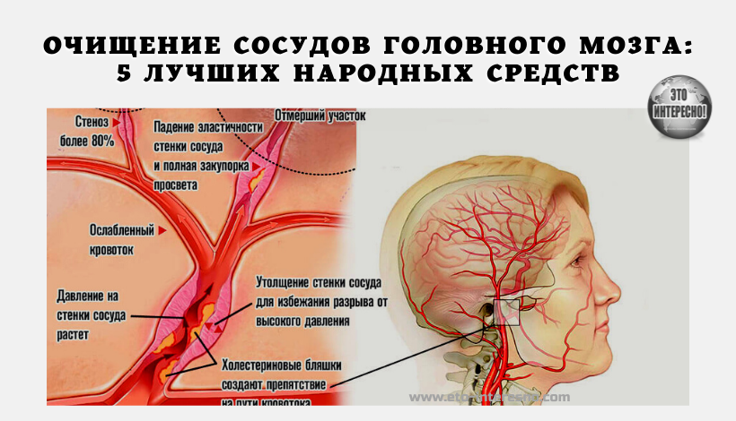 ОЧИЩЕНИЕ СОСУДОВ ГОЛОВНОГО МОЗГА: 5 ЛУЧШИХ НАРОДНЫХ СРЕДСТВ